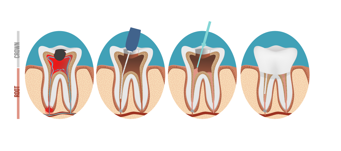 درمان ریشه دندان یا عصب کشی