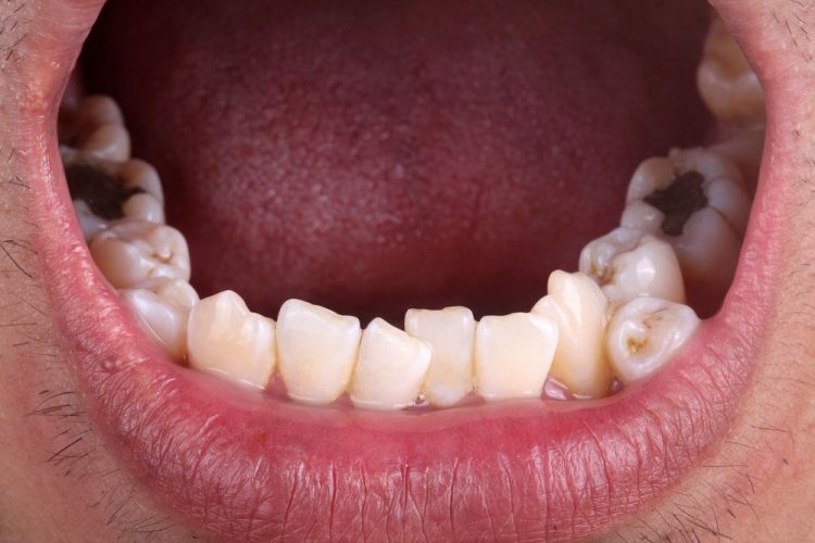هایپردونتیا - دندان های اضافی